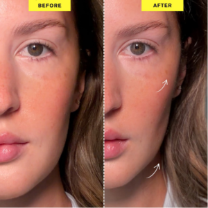 ZIIP Halo before and after