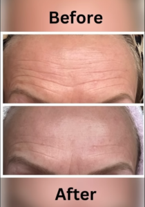 Beauty device for wrinkles
