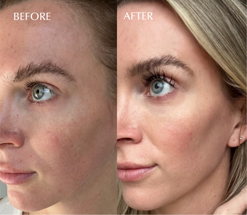 ZIIP Halo before and after
